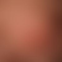 Tinea capitis superficialis: easily inflammable, blurred, alopecic focus in the occipital region ...