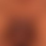 Verrucae vulgares: multiple, brownish, in places beet-like aggregated, soft verrucous growths. pr...