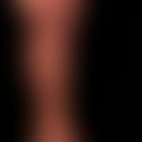 Schwerste leukozytoklastische Vaskulitis: multiple, homgen wie auch mehrschichtig konfigurierte F...