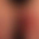 Zellulitis eosinophile: akute Bildung umschriebener, großflächiger, scharf beränderter Plaques. D...