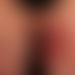 Zellulitis eosinophile: akute Bildung umschriebener, großflächiger, scharf beränderter Plaques. D...