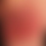 Zellulitis eosinophile: akute Ausprägung umschriebener, großflächiger, scharf beränderter Plaques...