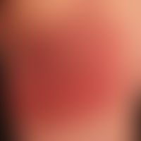 Zellulitis eosinophile: akute Ausprägung umschriebener, großflächiger, scharf beränderter Plaques...