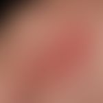 Zoster: in segmentaler Verteilung, gruppierte Bläschen und Pusteln auf geröteter Haut bei einem 5...
