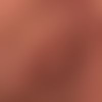 Differential diagnosis sarcoidosis of the skin: present is an anular granulomatous inflammation i...