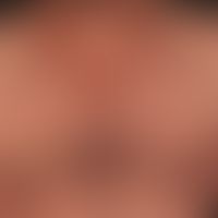 Spätsyphilis: asymmetrische, narbig abheilende, bizarr konfigurierte, braune, oberflächenglatte P...