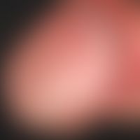 Balanitis candidamycetica: inflammatory (itchy and non-painful) lesions of the glans penis for se...
