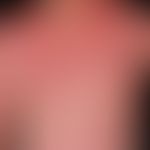 Kontaktdermatitis:&nbsp; toxische Kontaktdermatitis nach intensiver UV-Bestrahlung.
