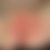Windeldermatitis: flächige vesikulöse, toxische&nbsp;Dermatitis im Windelbereich.
