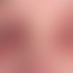Lidödeme: persistierende Lidödeme bei Dermatomyositis.&nbsp;
