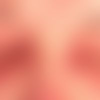 Differenzialdiagnose:Liddermatitis

Diagnose: vorliegend persistierende (nicht juckende) rote PLa...