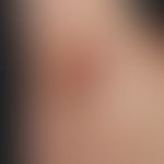 Acne inversa: multiple, chronisch stationäre, intertriginös lokalisierte, disseminierte, flach el...