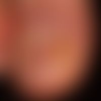 Acrodermatitis continua suppurativa:&nbsp; seit Jahren chronisch rezidivierendes Krankheitsbild m...