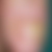 Acrodermatitis continua suppurativa: a pustular disease with a relapsing course that has been pre...