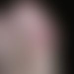 Dorsal cyst, mucoid: painless, approximately 1.5 cm large, skin-coloured, plump, elastic, surface...