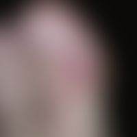 Dorsal cyst, mucoid: painless, approximately 1.5 cm large, skin-coloured, plump, elastic, surface...