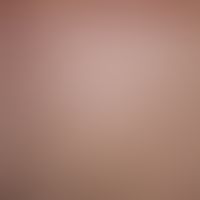 Malasseziafolliculitis: disseminated, follicle-bound, inflammatory, 0.5-3 mm papules and papulopu...