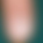 Dorsal cyst, mucoid: painless, approximately 1.0 cm large, skin-coloured, plump, elastic, surface...