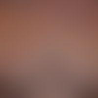 Mononukleose infektiöse: akute aufgetretenes, wenig juckendes, makulo-papulöses Exanthem. Begleit...