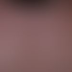 Mononucleosis infectious: acutely occurring, little itching, dense maculo-papular exanthema, acco...