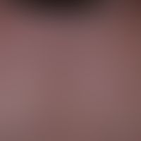 Mononukleose infektiöse: akute aufgetretenes, wenig juckendes, dichtes makulo-papulöses Exanthem....