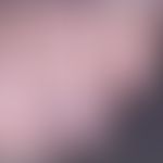Nagelhämatom: nicht ganz frisches subunguales Hämatom, nach stoßverletzung. Einblutung unter die ...