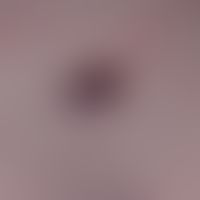 Hemangioma targetoides hemosiderotic: asymptomatic, violet to brownish papules and nodules surrou...