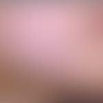 Molluscum contagiosum (kleinpapulöser Typ): Fokale Aussaat kleinpapulöser hautfarbener, glatter E...