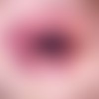 Haemangioma targetoides haemosiderotic: dermatoscopic image with sinosidal vascular dilatations. ...