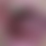 angiofibroma of the oral mucosa: nodularly distended angiofibroma of the oral mucosa. no signs of...