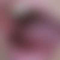 angiofibroma of the oral mucosa: nodularly distended angiofibroma of the oral mucosa. no signs of...