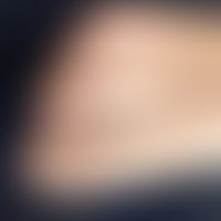 Großzehennageldystrophie kongenitale: seit Geburt bestehende Nageldystrophie mit unförmig aufgetr...