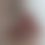 Roacea papulo-pustulosa. Abbildung&nbsp;entnommen aus&nbsp;&nbsp;Dr. Willan, Cutaneous Diseases f...