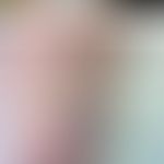 Positives Pricktestergebnise mit Polyäthylenglykolen unterschiedlicher Molekülgröße (entnommen au...