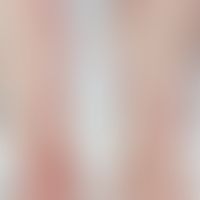COVID-19-Infektionen Hautveränderungen: Erythema multiforme bei COVID-19-Infektion (Abbildung ent...