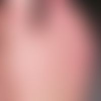Pseudo-Chilblain-Lupus: Frostbeulenartige Veränderungen im Rahmen einer COVID-19-Infektion (Pseud...