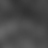 Follikelstau; Laser Scanning Mikroskopie: Perforation des Haarfollikels im oberen Corium mit Entz...
