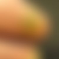 Onychogrypose: Mann, 85 Jahre. Seit Jahren bestehende Verdickung des re GZN mit typischen Querril...