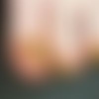 Onychogrypose: verkrümmte und verdickte Nägel mit seitlicher Deviation der Wachstumsrichtung; kei...