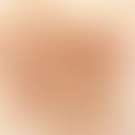 Basalzellkarzinom pigmentiertes: Auflichtmikroskopie: , wenig Pigment, unregelmäßig im Randwall, ...