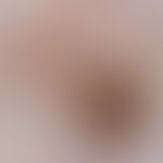 Basalzellkarzinom, pigmentiertes (Auflichtmikroskopie):&nbsp;blauschwarze Pigmentschollen unregel...