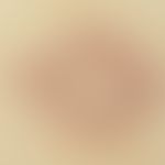 Molluscum contagiosum, Auflichtmikroskopie, hohe Vergrößerung: kleine, zentral genabelte Papel mi...