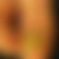 Onychogrypose: 75-jähriger Mann. Isoliert nur der rechte GZN betroffen. Der Patient berichtet, da...