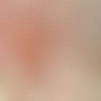 Pemphigus foliaceus. Auflichtmikroskopie: Fragile, intraepidermale Blase am Kieferwinkel einer 72...