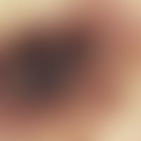 Angiom seniles: thrombosiertes seniles Angiom, Auflichtmikroskopie: Zentral dunkelvioletter Throm...