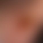 Chondrodermatitis nodularis chronica helicis, Auflichtmikroskopie: chronisches, hochschmerzhaftes...