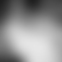 Chondrodermatitis nodularis chronica helicis, Laser Scanning Mikroskopie, subepidermal mit dicht ...