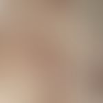 Frontal fibrosierende Alopezie, Auflichtmikroskopie: Wenige Einzelhaare (lonely hairs)&nbsp;in na...