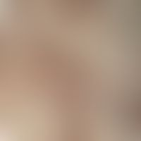 Frontal fibrosierende Alopezie, Auflichtmikroskopie: Wenige Einzelhaare (lonely hairs)&nbsp;in na...