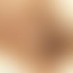 Seborrhoische Keratose, Auflichtmikroskopie: gepunzte Oberfläche mit zahlreichen z.T. weißen, ges...